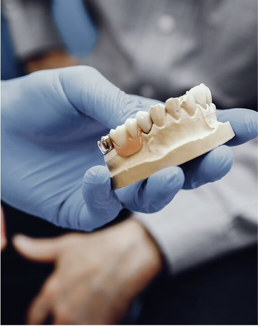 Implantes