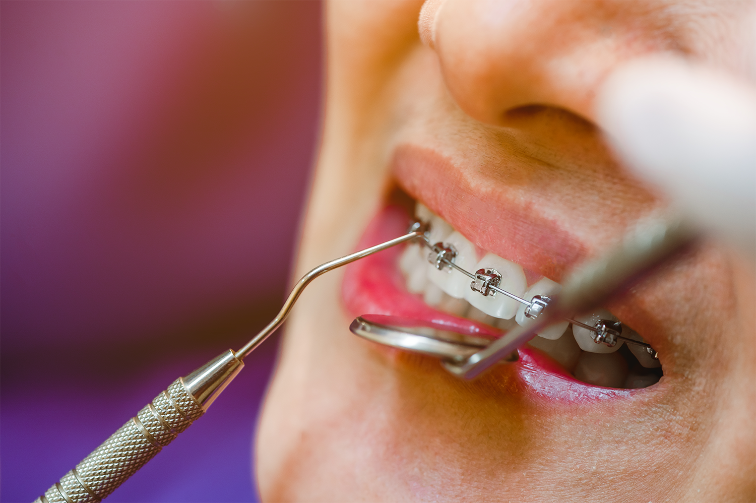 close-up-of-teeth-with-metal-braces-2026-03-16-22-55-57-utc