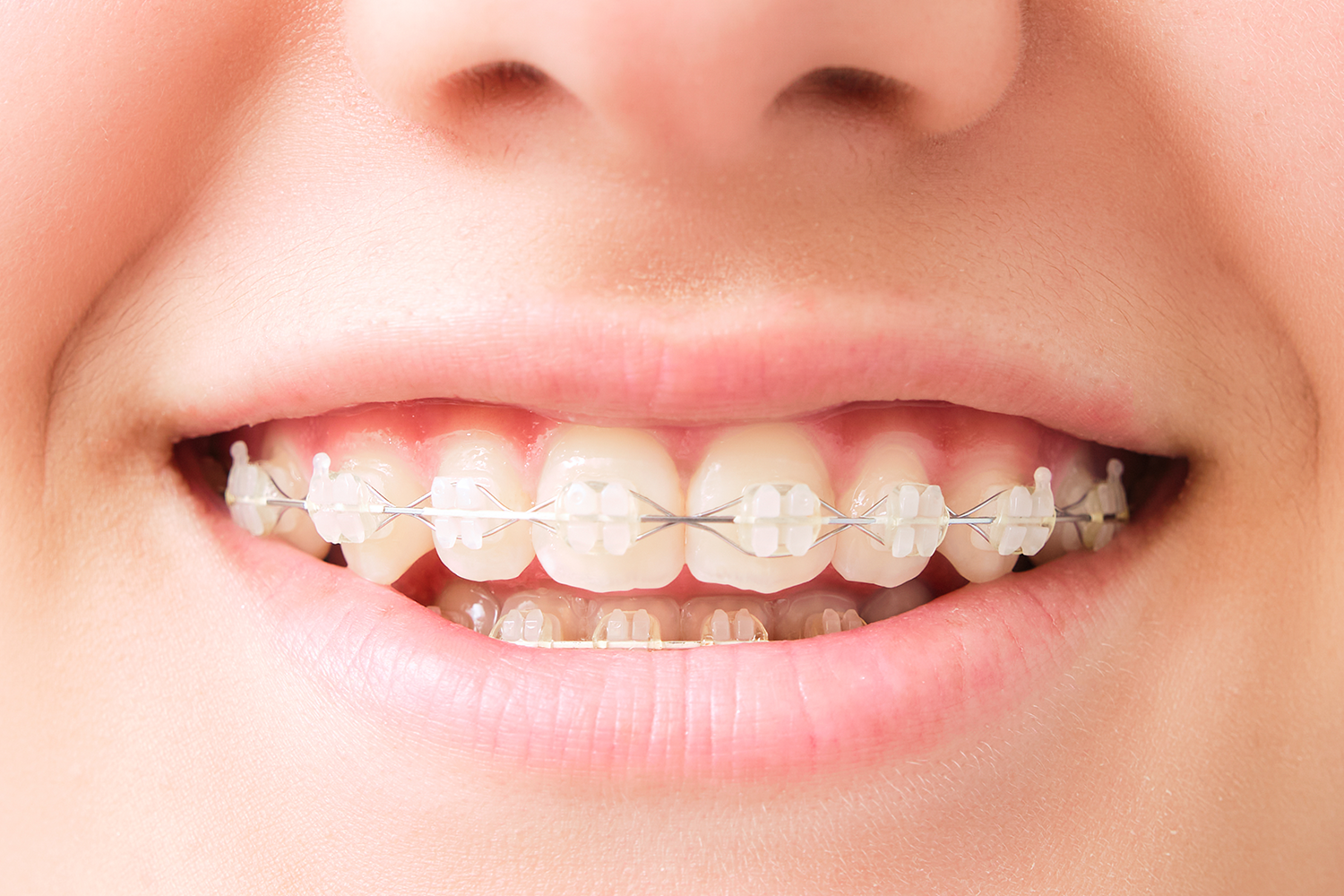 teen-smiling-with-braces-on-teeth-close-up-2026-09-21-14-05-51-utc