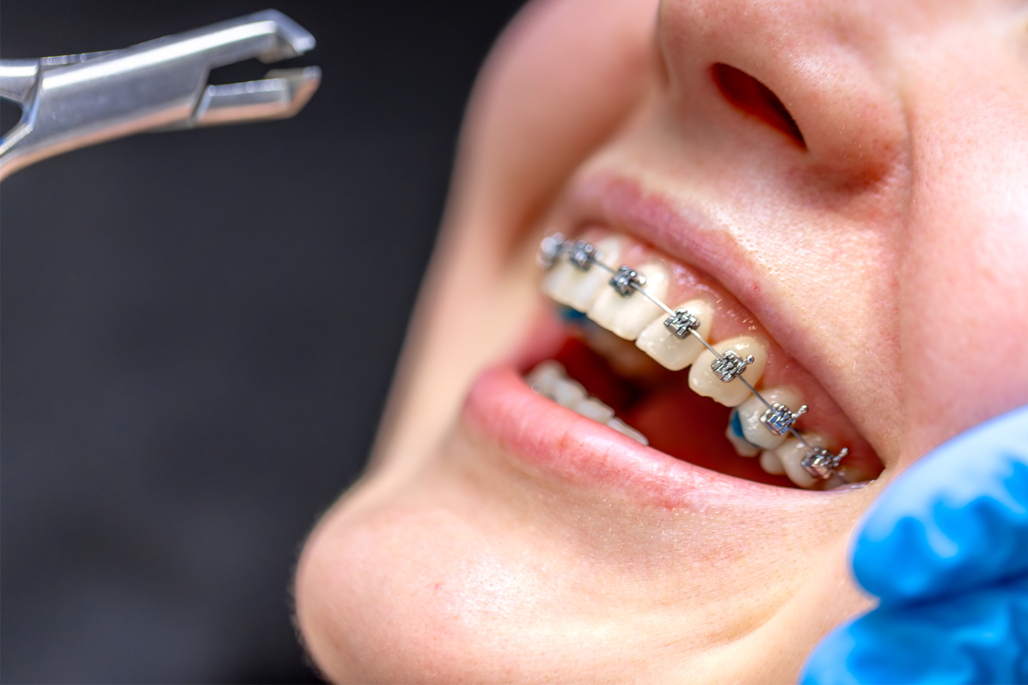 woman-having-braces-fitted-at-the-dentist-2026-03-25-03-54-16-utc