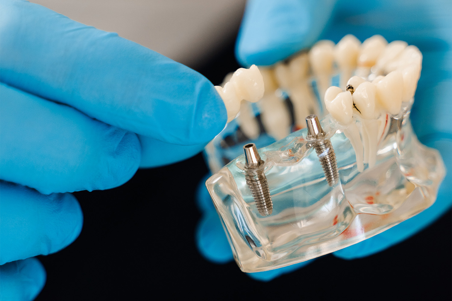 dental-implant-model-being-examined-at-the-clinic-2026-09-25-02-10-03-utc